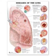 ACC Diseases of The Lung Anatomical Chart