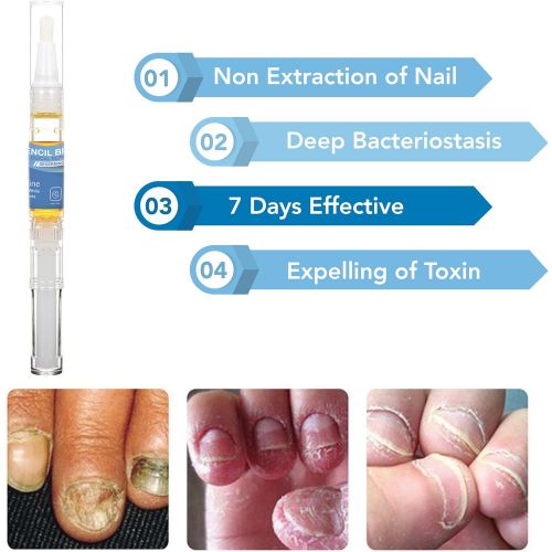  [아마존핫딜][아마존 핫딜] Arishine Fungus Treatment, Fungus Stop, Anti Fungus Nail Treatment, Effective Against Nail Fungus, Anti Fungal Nail Solution, Toenails and Fingernails Solution (2 Pack)