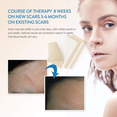   [아마존핫딜]Aroamas Professional Silicone Scar Sheets, Soften and Flattens Scars Resulting from Surgery, Injury,...
