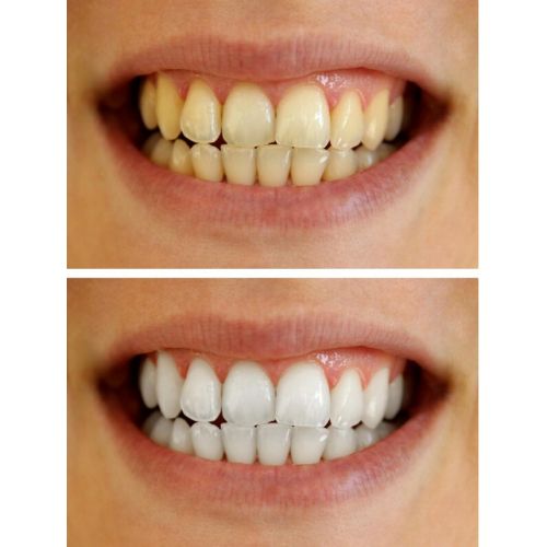  Bleach Pro Whitening 50 Teeth Whitening Gel 22% Carbamide Peroxide 10ml Syringes