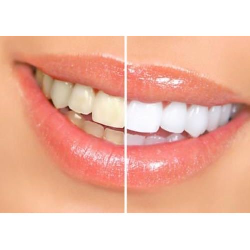  Bright White Smiles Teeth Whitening Refill Gel Kit (4) 10cc Syringes (Tooth Whitener Only) 44%...