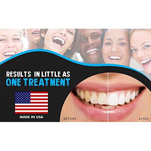  BrightWhiteSmiles Bright White Smiles Teeth Whitening Kit, 35% Carbamide Peroxide Gel for Professional Results at...