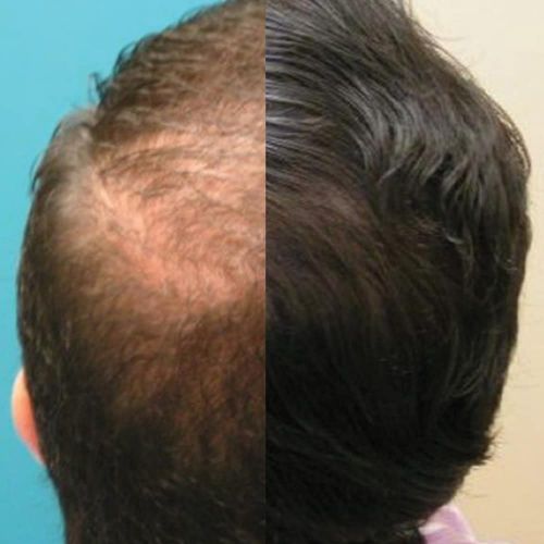  Capillus202 Hair Care Laser Treatment & 3 Hair Care Bundles for Treating Hair Loss - New...