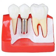 Christzo 4 Times Teeth Model Dental Implant Analysis Crown Bridge Demonstration Dental Teeth...