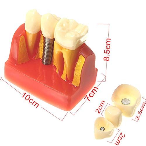  Christzo 4 Times Teeth Model Dental Implant Analysis Crown Bridge Demonstration Dental Teeth...