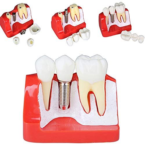  Christzo 4 Times Teeth Model Dental Implant Analysis Crown Bridge Demonstration Dental Teeth...