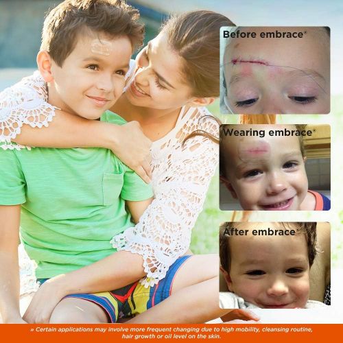  Embrace Scar Treatment, Silicone Sheets for New Scars with Active Scar Defense, Small 1.6 Inch Sheets, 6 Count, Recommended Full Treatment (60 Day Supply)