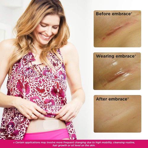  Embrace Scar Treatment, Silicone Sheets for New Scars with Active Scar Defense, Medium 2.4 Inch Sheets, 6 Count, Recommended Full Treatment (60 Day Supply)