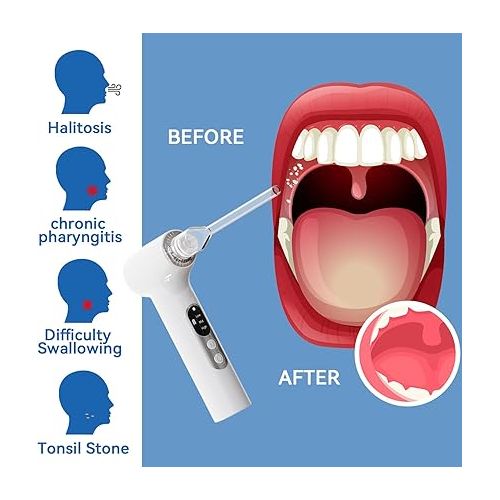 제네릭 Tonsil Stone Removal kit-Tonsil Stone Remover Vacuum-Rechargeable Tonsil Stone Remover-Fresh Breath-Oral Irrigator