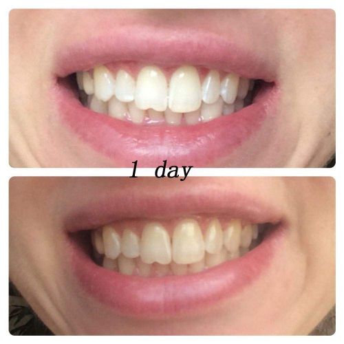  Glory Smile GlorySmile Teeth Whitening Kit within Teeth Whitening Accelerator, 35% Carbamide Peroxide,...