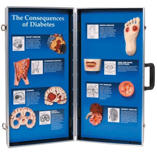  HEALTH EDCO W43081D Consequences of Diabetes 3D Display, 28 Length x 27 Height Opened