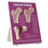 HEALTH EDCO W43124 Loss of Bone Easel Display, 9 Length x 12 Height