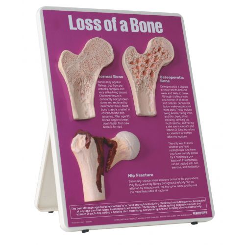  HEALTH EDCO W43124 Loss of Bone Easel Display, 9 Length x 12 Height