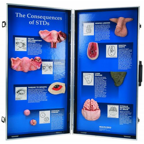  HEALTH EDCO W43089 The Consequences of STDs 3D Display, 69cm Length x 71cm Height Opened