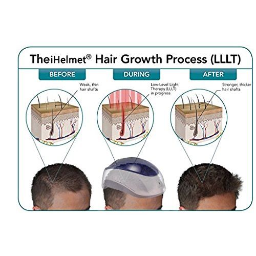  IHelmet Hair Growth Helmet  Low Level Light Therapy Hair Loss Treatment for Men & Women  FDA Cleared,...