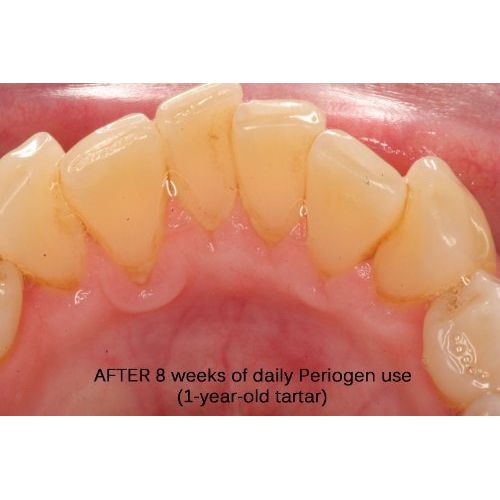  Periogen Rinse for Complete Oral Health: the only Product in the World that Removes Dental Tartar...