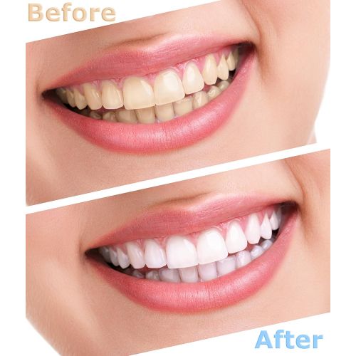  Polar Teeth Whitening Gel Refill Kit contains months of Teeth Whitening and...