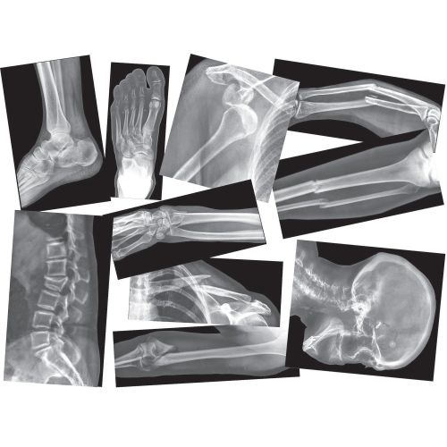  Roylco Broken Bones X-Ray Set