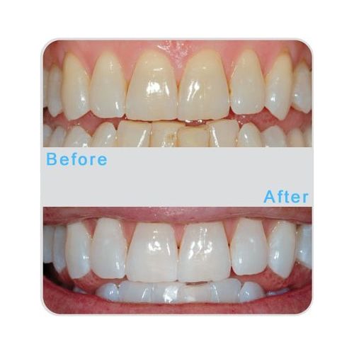  Sparkling White Smiles Professional Custom Teeth Tooth Whitening Trays. Includes 4 XL 10ml Syringes of 16% Gel....