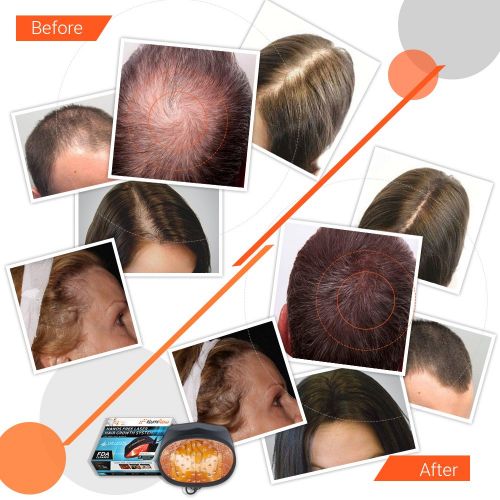 Illumiflow 272 Diodes, FDA Cleared Laser Helmet for Thinning Hair Loss Treatment for Men and Women. Light Stimulates Hair Follicles for Thicker Hair Regrowth.