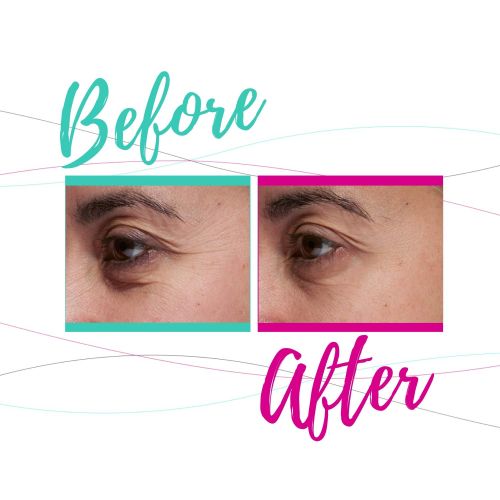  Tria Beauty Age-Defying Eye Wrinkle Correcting Laser  FDA cleared  younger looking skin in as little as 2 weeks