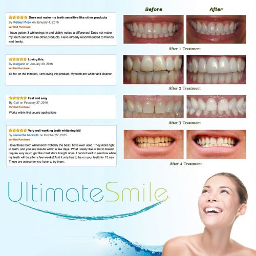  Ultimate Smile Professional Home Teeth Whitening Kit - 35% Carbamide Peroxide Tooth Whitening...