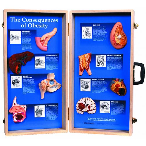  HEALTH EDCO W43057 The Consequences of Obesity 3D Display, 27 Length x 28 Height Opened