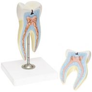 EISCO Upper Triple Root Molar with Caries Model, Enlarged 15 Times, 2 Parts, Hand Painted